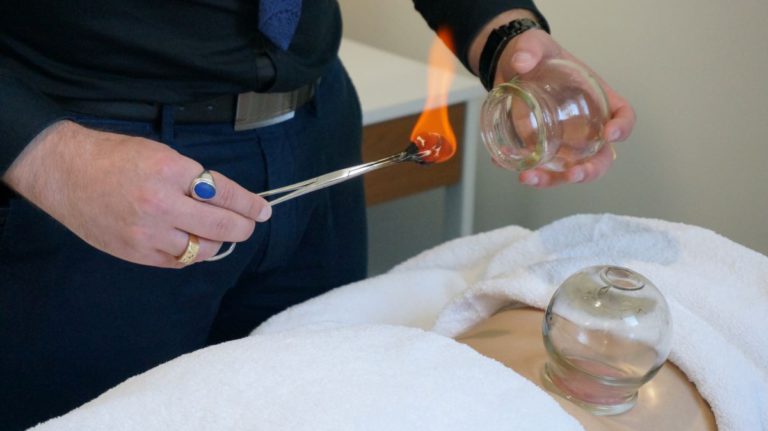 Cupping Therapy in Melbourne: Experience Healing Benefits Now