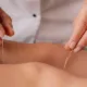 Acupuncture for Stress and Anxiety Relief: A Complete Guide
