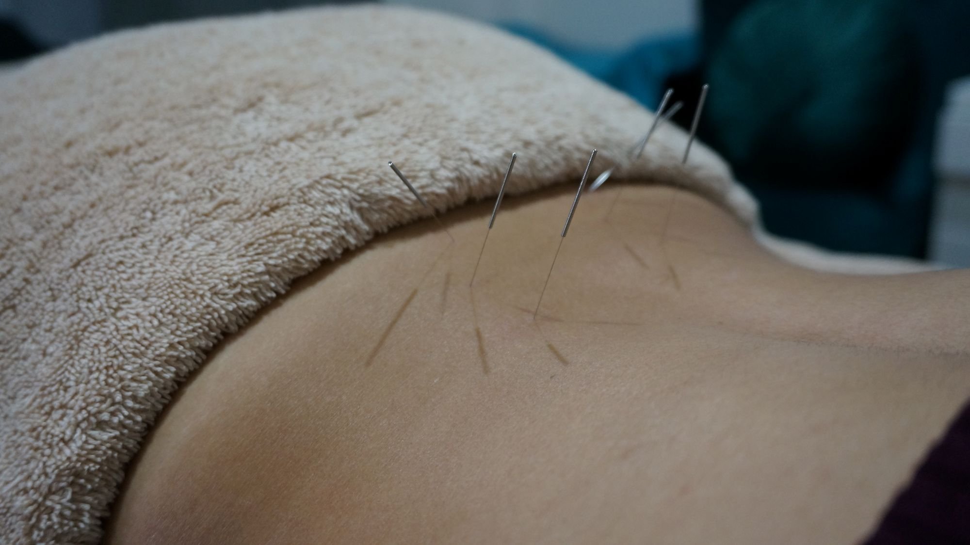 A calming acupuncture treatment room