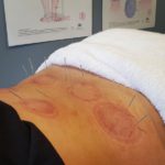 Sports Recovery Acupuncture: Discover 6 Essential Benefits